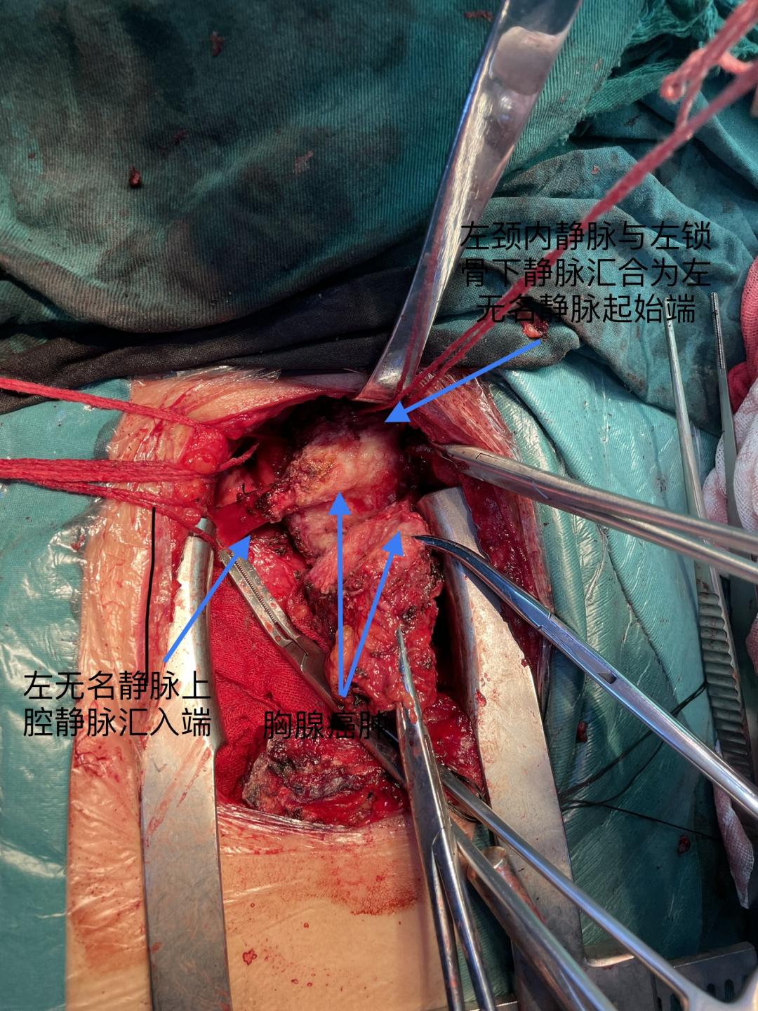 心包膜手术攻略(心包膜切除术多久能恢复)